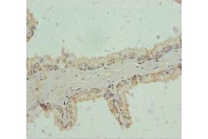 Immunohistochemistry of paraffin-embedded human prostate cancer using ABIN7151192 at dilution of 1:100 (RNF34 antibody  (AA 1-220))