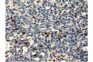 Immunohistochemical staining of paraffin-embedded Adenocarcinoma of Human ovary tissue using anti-MICAL1 mouse monoclonal antibody. (MICAL1 antibody)