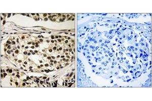 Immunohistochemistry analysis of paraffin-embedded human breast carcinoma, using Cyclin C (Phospho-Ser275) Antibody. (Cyclin C antibody  (pSer275))