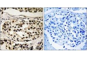 Immunohistochemistry analysis of paraffin-embedded human breast carcinoma, using Cyclin C (Phospho-Ser275) Antibody.