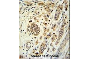 FBXL15 Antibody (C-term) (ABIN651414 and ABIN2840224) immunohistochemistry analysis in formalin fixed and paraffin embedded human breast carcinoma followed by peroxidase conjugation of the secondary antibody and DAB staining. (FBXL15 antibody  (C-Term))
