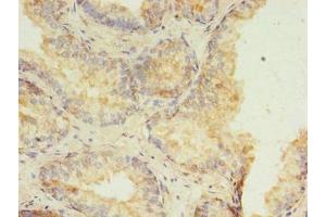 Immunohistochemistry of paraffin-embedded human prostate cancer using ABIN7155196 at dilution of 1:100 (HMGN3 antibody  (AA 1-77))
