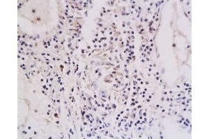 Formalin-fixed and paraffin embedded human oral squamous cell carcinoma labeled with Anti-TNFRSF18 Polyclonal Antibody , Unconjugated at 1:200, followed by conjugation to the secondary antibody and DAB staining