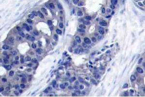 Immunohistochemistry analysis of human breast carcinoma tissue (Formalin-fixed, Paraffin-embedded) using IRS1 antibody . (IRS1 antibody)