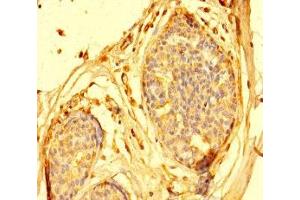 Immunohistochemistry of paraffin-embedded human breast cancer using ABIN7144032 at dilution of 1:100