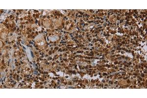 Immunohistochemistry of paraffin-embedded Human thyroid cancer using TBX5 Polyclonal Antibody at dilution of 1:35 (T-Box 5 antibody)