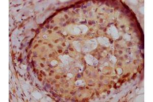 IHC image of ABIN7127675 diluted at 1:100 and staining in paraffin-embedded human breast cancer performed on a Leica BondTM system. (Recombinant PELP1 antibody)