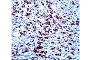 Immunohistochemical staining of APOA5 on paraffin-embedded human anaplastic lymphoma with APOA5 monoclonal antibody, clone 1G5G9 . (APOA5 antibody)
