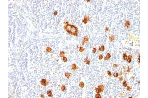 Formalin-fixed, paraffin-embedded human Hodgkin's Lymphoma stained with CD15 Mouse Monoclonal Antibody (FUT4/815). (CD15 antibody)