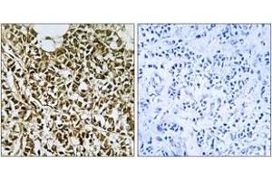 Immunohistochemistry analysis of paraffin-embedded human breast carcinoma tissue, using RPC5 Antibody. (POLR3E antibody  (AA 191-240))