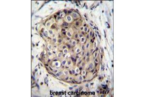 GMPR Antibody immunohistochemistry analysis in formalin fixed and paraffin embedded human breast carcinoma followed by peroxidase conjugation of the secondary antibody and DAB staining. (NT5C2 antibody  (C-Term))