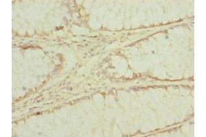 Immunohistochemistry of paraffin-embedded human colon cancer using ABIN7151546 at dilution of 1:100 (EEF1G antibody  (AA 168-437))