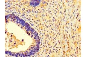 Immunohistochemistry of paraffin-embedded human ovarian cancer using ABIN7142435 at dilution of 1:100 (MRPL39 antibody  (AA 1-158))