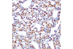 Immunohistochemistry of paraffin-embedded human liver cancer using T Rabbit pAb (ABIN7270794) at dilution of 1:100 (40x lens). (TAB3 antibody)