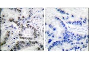 Immunohistochemistry analysis of paraffin-embedded human lung carcinoma tissue, using CBP (Acetyl-Lys1535) Antibody. (CBP antibody  (acLys1535))