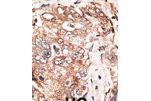 Formalin-fixed and paraffin-embedded human cancer tissue reacted with the primary antibody, which was peroxidase-conjugated to the secondary antibody, followed by DAB staining. (TPX2 antibody  (AA 350-382))