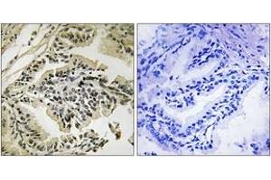 Immunohistochemistry analysis of paraffin-embedded human prostate carcinoma, using PEK/PERK (Phospho-Thr981) Antibody. (PERK antibody  (pThr981))