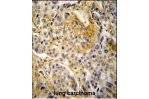 NCF1 Antibody (N-term) (ABIN652063 and ABIN2840531) immunohistochemistry analysis in formalin fixed and paraffin embedded human lung carcinoma followed by peroxidase conjugation of the secondary antibody and DAB staining. (NCF1 antibody  (N-Term))
