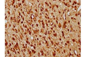 IHC image of ABIN7150177 diluted at 1:10 and staining in paraffin-embedded human glioma performed on a Leica BondTM system.