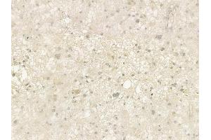 ABIN6258282 and ABIN6275194 at 1/100 staining human astrocytoma by IHC-P.