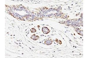 Formalin-fixed, paraffin-embedded human breast carcinoma stained with SMMHC antibody (MYH11/923).