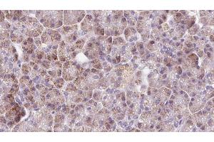 ABIN6273230 at 1/100 staining Human pancreas cancer tissue by IHC-P.