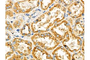 ABIN6257428 and ABIN6275868 at 1/100 staining Human kidney cancer and adjacent normal tissues by IHC-P.