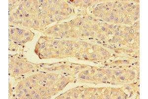 Immunohistochemistry of paraffin-embedded human liver cancer using ABIN7172023 at dilution of 1:100 (Peroxiredoxin 3 antibody  (AA 63-256))