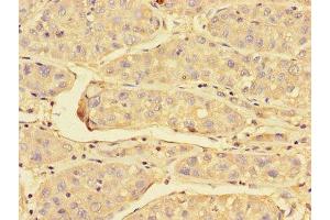 Immunohistochemistry of paraffin-embedded human liver cancer using ABIN7172023 at dilution of 1:100