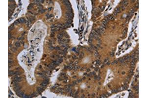 The image on the left is immunohistochemistry of paraffin-embedded Human colon cancer tissue using ABIN7129488(FGF18 Antibody) at dilution 1/20, on the right is treated with fusion protein. (FGF18 antibody)