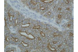 Detection of cytokeratin on paraffin-embedded sections of guinea pig breast carcinoma using anti-cytokeratin antibody (pan Keratin antibody)