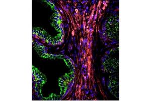 Confocal immunofluorescent analysis of CYK18 Antibody (C-term) (ABIN391561 and ABIN2841501) with prostate carcinoma followed by Alexa Fluor 488-conjugated goat anti-rabbit lgG (green). (Cytokeratin 18 antibody  (C-Term))