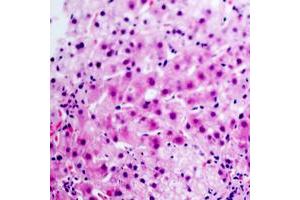 Immunohistochemical analysis of Glucagon staining in human liver cancer formalin fixed paraffin embedded tissue section. (Glucagon antibody  (Center))