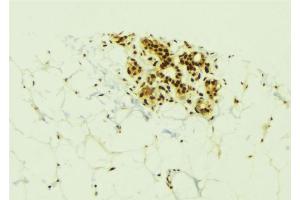 ABIN6273834 at 1/100 staining Human breast cancer tissue by IHC-P. (Kallikrein 6 antibody  (C-Term))