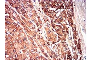 Immunohistochemical analysis of paraffin-embedded liver cancer tissues using SAA1 mouse mAb with DAB staining.