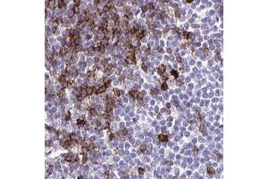 Immunohistochemical staining (Formalin-fixed paraffin-embedded sections) of human lymphoma with SPN polyclonal antibody  shows strong cytoplasmic positivity in a subset of tumor cells. (CD43 antibody  (AA 315-394))