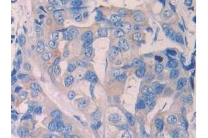 Detection of RNLS in Human Breast cancer Tissue using Polyclonal Antibody to Renalase (RNLS) (RNLS antibody  (AA 160-319))