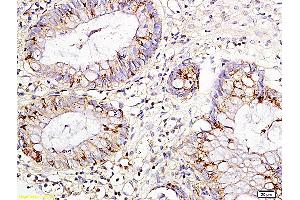 Formalin-fixed and paraffin embedded colitis labeled with Anti-IL-15, Unconjugated (ABIN735053) followed by conjugation to the secondary antibody and DAB staining (IL-15 antibody  (AA 81-162))