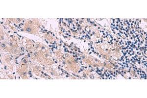 Immunohistochemistry of paraffin-embedded Human liver cancer tissue using NMRK2 Polyclonal Antibody at dilution of 1:55(x200)