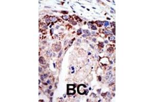 Formalin-fixed and paraffin-embedded human cancer tissue reacted with the primary antibody, which was peroxidase-conjugated to the secondary antibody, followed by AEC staining.