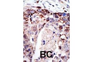 Formalin-fixed and paraffin-embedded human cancer tissue reacted with the primary antibody, which was peroxidase-conjugated to the secondary antibody, followed by AEC staining. (Ataxin 3 antibody  (N-Term))