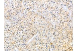 ABIN6266031 and ABIN6269398 at 1/100 staining human hepatocellular carcinoma by IHC-P. (WNK1 antibody  (N-Term))
