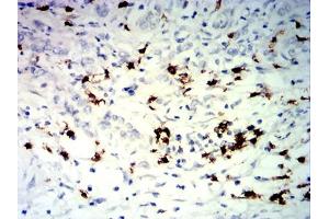 Immunohistochemical analysis of paraffin-embedded stomach cancer tissues using TNFRSF25 mouse mAb with DAB staining. (DR3/LARD antibody)