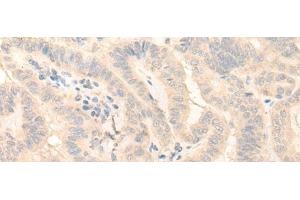 Immunohistochemistry of paraffin-embedded Human thyroid cancer tissue using HMBS Polyclonal Antibody at dilution of 1:25(x200) (HMBS antibody)
