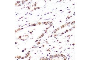 Immunohistochemistry of paraffin-embedded human colon carcinoma using TriMethyl-Histone H3-K27 antibody (ABIN7267698) at dilution of 1:25 (40x lens). (Histone 3 antibody  (H3K27me3))