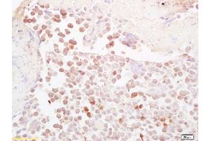 Formalin-fixed and paraffin embedded mouse colon carcinoma labeled with Anti-NQO1 Polyclonal Antibody, Unconjugated (ABIN678428) at 1:200, followed by conjugation to the secondary antibody and DAB staining (NQO1 antibody  (AA 201-274))