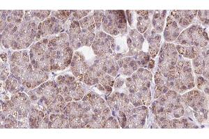 ABIN6273243 at 1/100 staining Human pancreas cancer tissue by IHC-P. (FBXO22 antibody  (Internal Region))