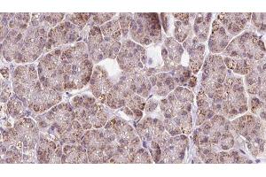 ABIN6273243 at 1/100 staining Human pancreas cancer tissue by IHC-P.