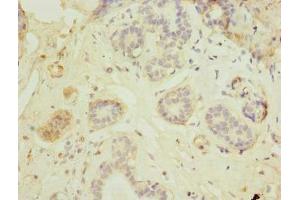 Immunohistochemistry of paraffin-embedded human breast cancer using ABIN7165622 at dilution of 1:100 (C17orf66 antibody  (AA 1-219))