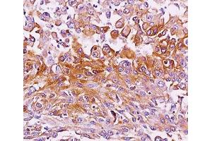 IHC testing of melanoma tissue stained with Melanoma antibody (NKI-beteb). (Melanoma antibody)